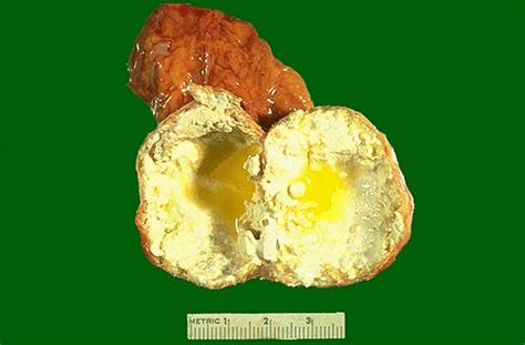 Endocrine Pathology