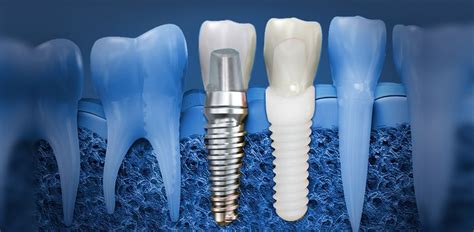 Mesa, AZ Dental Implants FAQ - Eastport Dental AZ