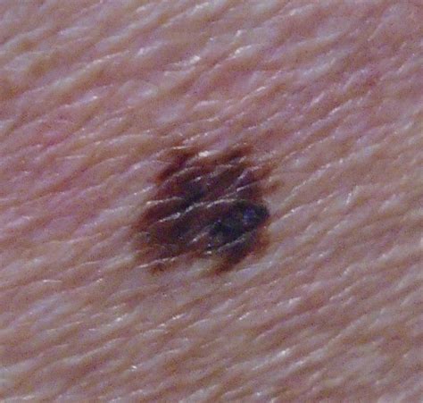 Dermoscopy | Melanoma skin cancer can be fatal unless caught early, but most skin lesions are ...