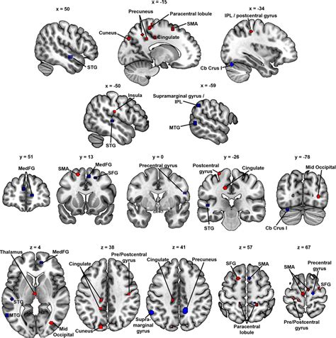 Increased gray matter in ADHD and dyslexia. Regions of statistically... | Download Scientific ...