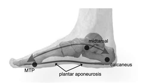 Midtarsal Joint Sprain - The Complete Treatment Guide