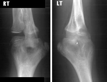 CONGENITAL RADIOULNAR SYNOSTOSIS