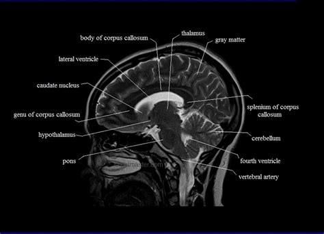 Hippocampus Mri Sagittal