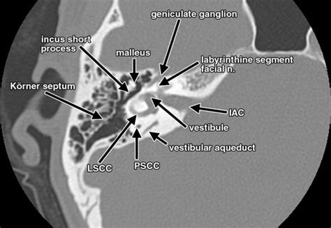 Temporal Bone Axial Ct Anatomy