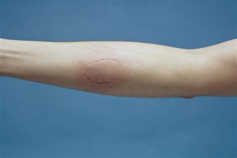 Human Bite: Causes, Symptoms, Risks, and Treatment