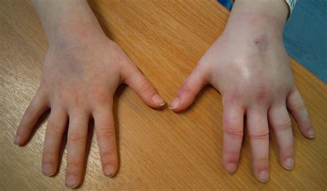 New onset unilateral arm swelling in a child with periorbital oedema ...