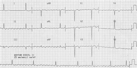 Atrial Flutter • LITFL • ECG Library Diagnosis