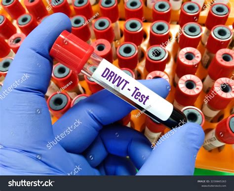 Blood Sample Drvvtdiluted Russell Viper Venom Stock Photo 2230665163 ...