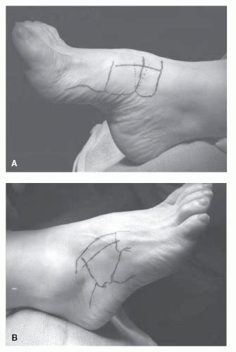 Pes Cavus Surgery | Musculoskeletal Key