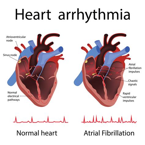 10 Symptoms of arrhythmia You Should Never Ignore - Huffington News