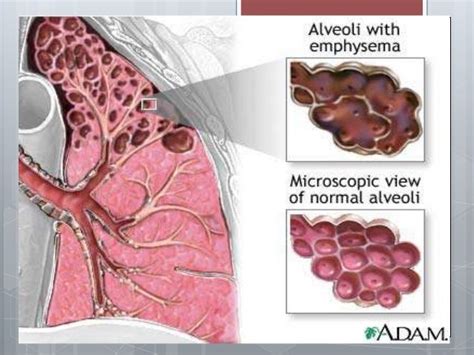 Pulmonary Emphysema. Pathomorphology, outcomes, complications