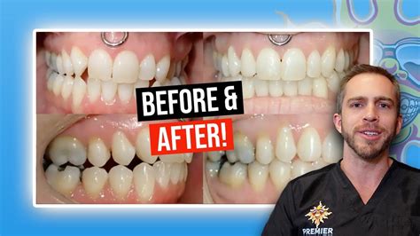 Missing Lateral Incisors w/ Braces?! (BEFORE & AFTER) - YouTube