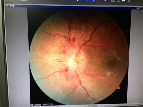 Optic Nerve Disease - Eye Specialist, Treatments, Types and Symptoms