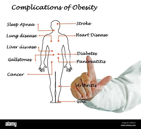 Complications of Obesity Stock Photo - Alamy