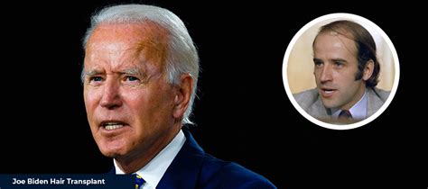 Joe Biden Hair Transplant - Smile Hair Clinic