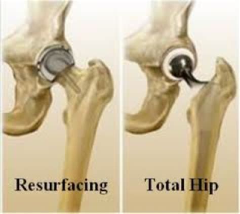 Hip resurfacing - Sudhir Rao - Knee Hip and Shoulder surgeon