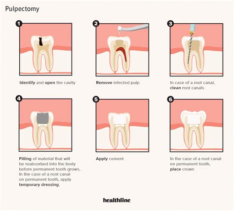 Pulpotomy Pulpectomy | Green Park Dental Hospital