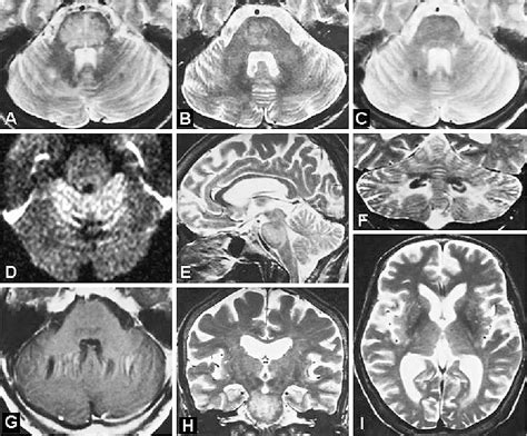 Figure 1 from Central pontine lesions observed with MRI in four diabetic patients. | Semantic ...