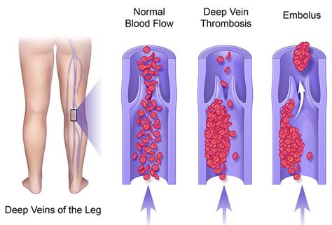 Full Guide on Understanding and Preventing Leg Blood Clots (DVT)