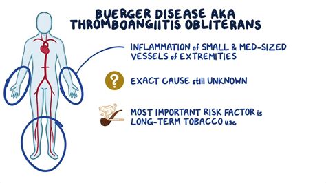 Buerger disease: Year of the Zebra: Video & Anatomy | Osmosis