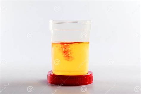 Blood in Urine Analysis As Idea Urogenital System Disease and Prostate Cancer. Disease Based on ...