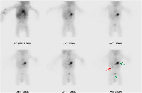 A Picture Is Worth a Thousand Words: A Case of Meckel’s Diverticulum ...