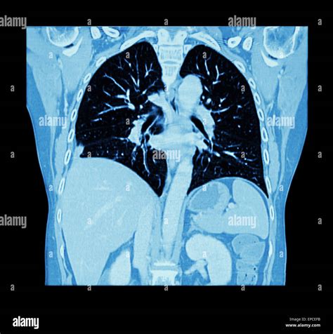 Lung cancer ( CT scan of chest and abdomen : show right lung cancer ...