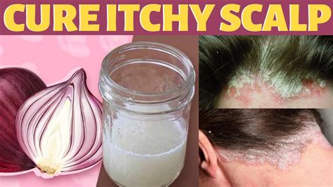 Itchy Scalp And Dandruff : ITCHY DRY SCALP | SCRATCHING DANDRUFF ...