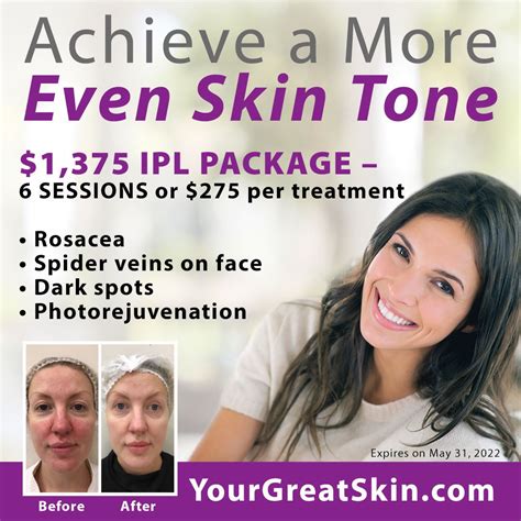 Special Pricing on IPL Laser Treatments - Your Great Skin