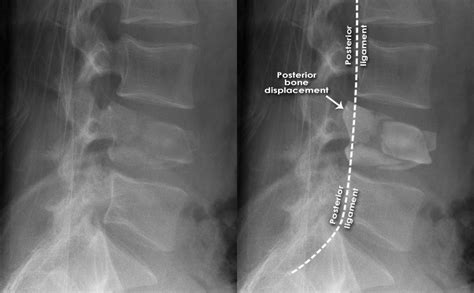 Pathological Fracture Spine