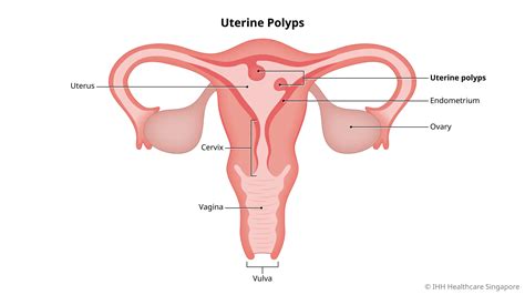 Endometrial Polyps - Symptoms & Causes | Mount Elizabeth Hospital