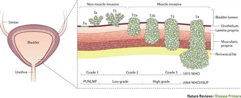 1: The types and stages of bladder cancer. Tis, Ta, and T1 types are... | Download Scientific ...