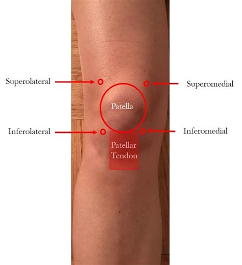 5 Things To Know about Knee Injections - Washington Orthopaedics & Sports Medicine