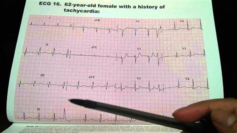 EKG ECG abnormality cardiology cardiologist electrocardiogram doctor www.drbenzur.com - YouTube
