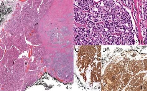 Medullary thyroid carcinoma. (A) Malignant neoplasia infiltrating ...