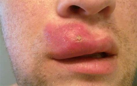 Treating Big, Painful, Infected Lip Pimples Fast | Skincarederm