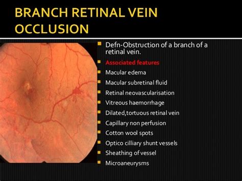 Retinal vein occlusions