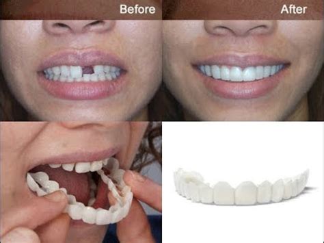 Removable Veneer For Perfect Teeth - YouTube