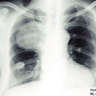 (PDF) A rare tumor of the lung: Sarcomatoid carcinoma