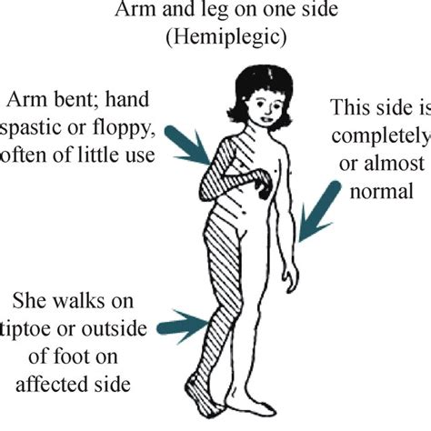 Subject with spastic hemiplegia [18] | Download Scientific Diagram