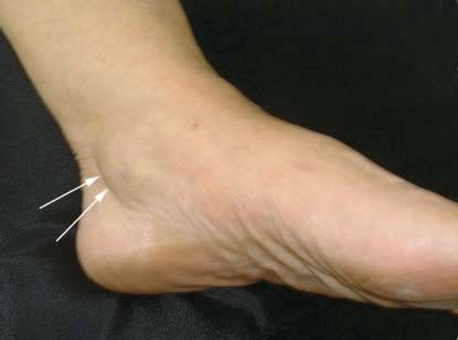 Posterior Tibialis Tendon Dysfunction (PTTD) - Lamberti Physiotherapy