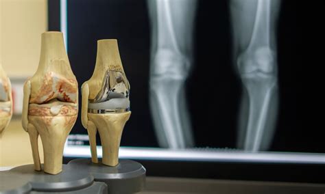 Dr. Barrett’s Blog: What’s new in Knee Replacement 2019 - Proliance Orthopedic Associates ...