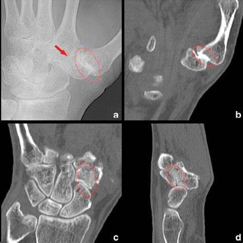 1st Cmc Joint Subluxation