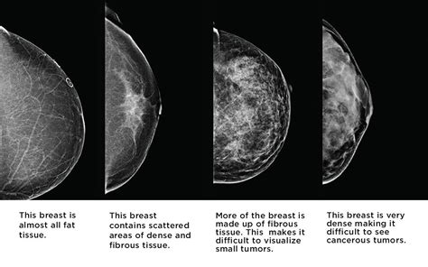 Mammogram or ultrasound or both? - Dr. Zembroski