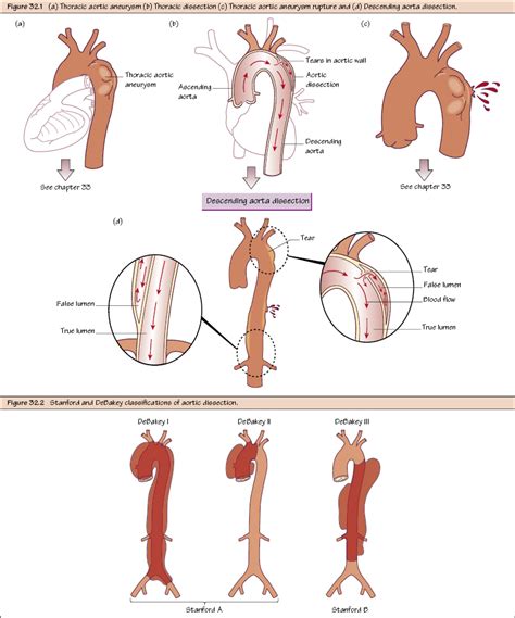 Thoracic Aortic Disease I: Dissection | Thoracic Key