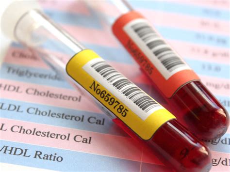 Triglyceride Level Test: Procedure, Preparation, and Risks