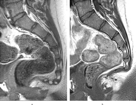 The treatment of coccydynia in adolescents | Bone & Joint