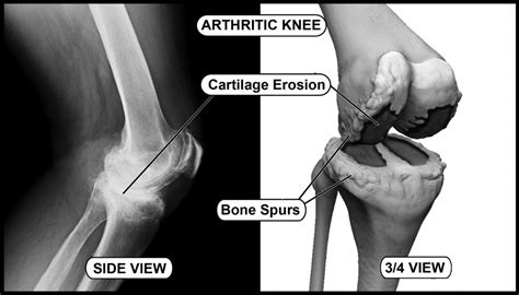 ~ Arthritic Hips & Knees Images – Hip and Knee Handbook of Joint Replacement