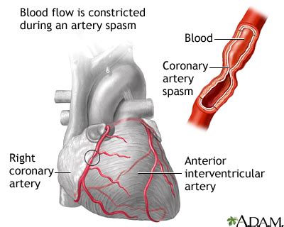 Coronary artery spasm: MedlinePlus Medical Encyclopedia Image