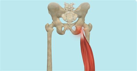 Sit Bone Pain Has More Than One Cause - Updated 2021 - Yoga Anatomy